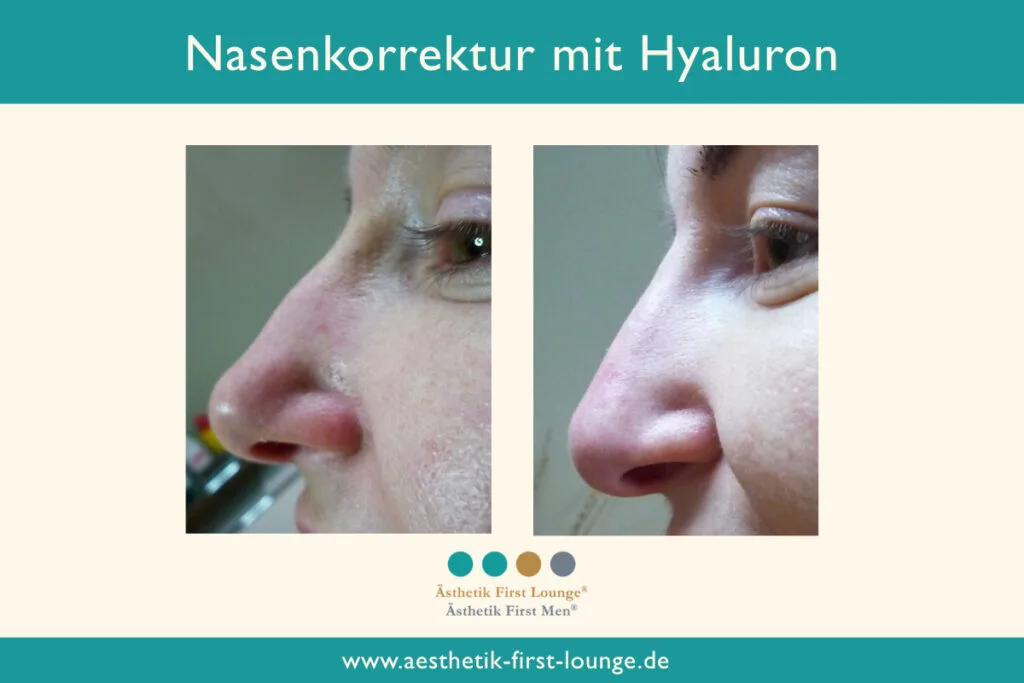 Nasenkorrektur ohne OP mit Hyaluron Beispiel 4 | Ästhetik First Lounge