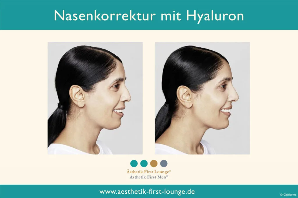 Nasenkorrektur ohne OP mit Hyaluron Beispiel 5 | Ästhetik First Lounge
