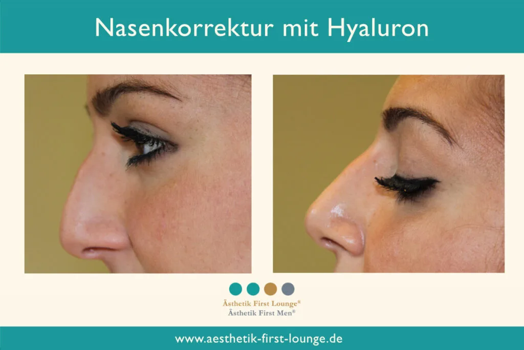 Nasenkorrektur ohne OP mit Hyaluron Beispiel 1 | Ästhetik First Lounge
