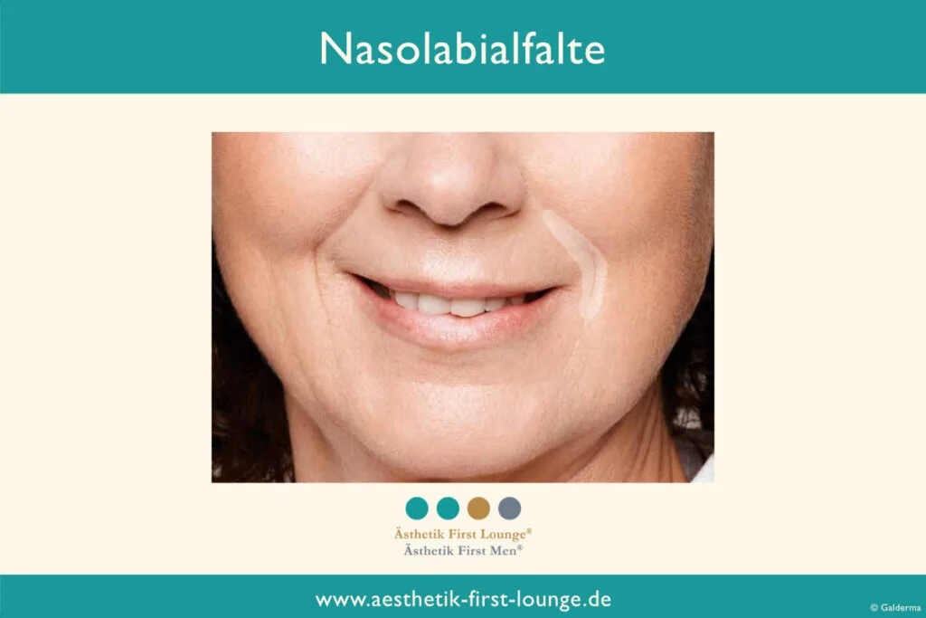 nasolabialfalte-unterspritzen-mit-hyaluron-aesthetik-first-lounge