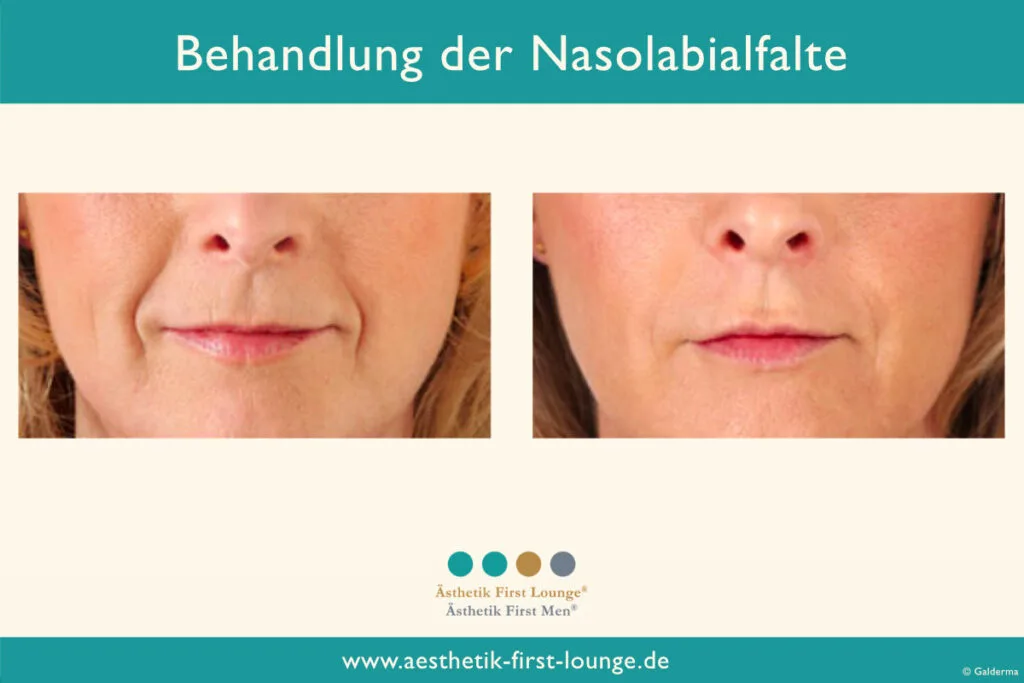 Nasolabialfalte unterspritzen mit Hyaluron Beispiel 2 | Ästhetik First Lounge