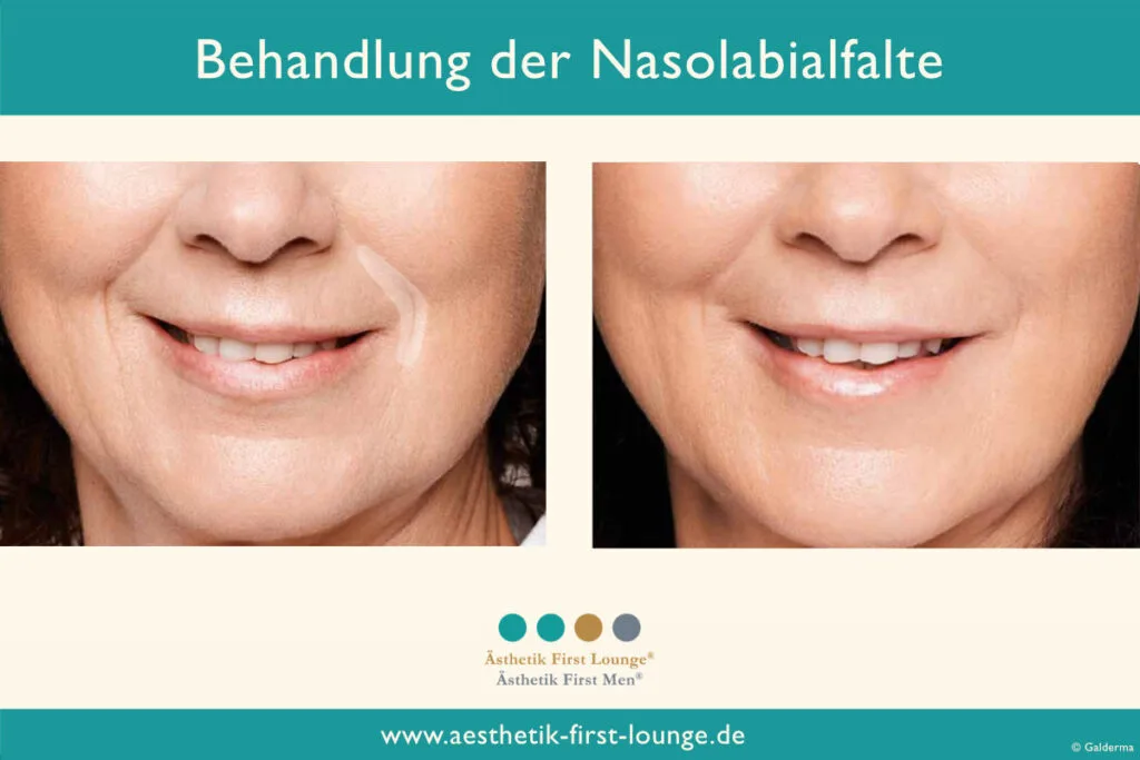 Nasolabialfalte unterspritzen mit Hyaluron Beispiel 4 | Ästhetik First Lounge