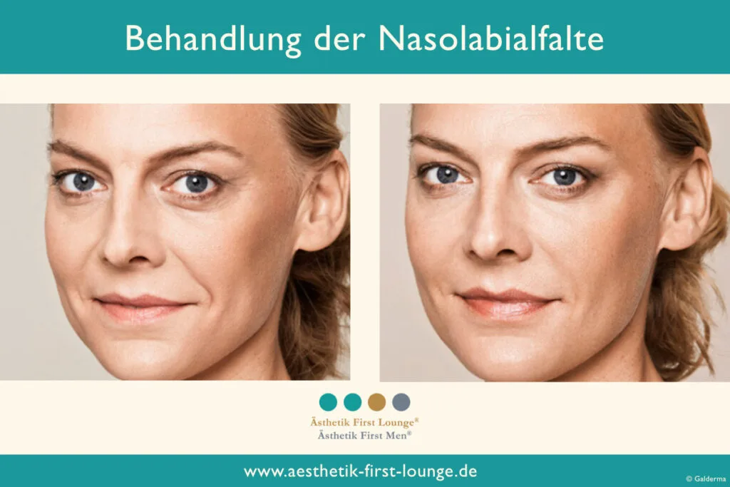 Nasolabialfalte unterspritzen mit Hyaluron Beispiel 5 | Ästhetik First Lounge