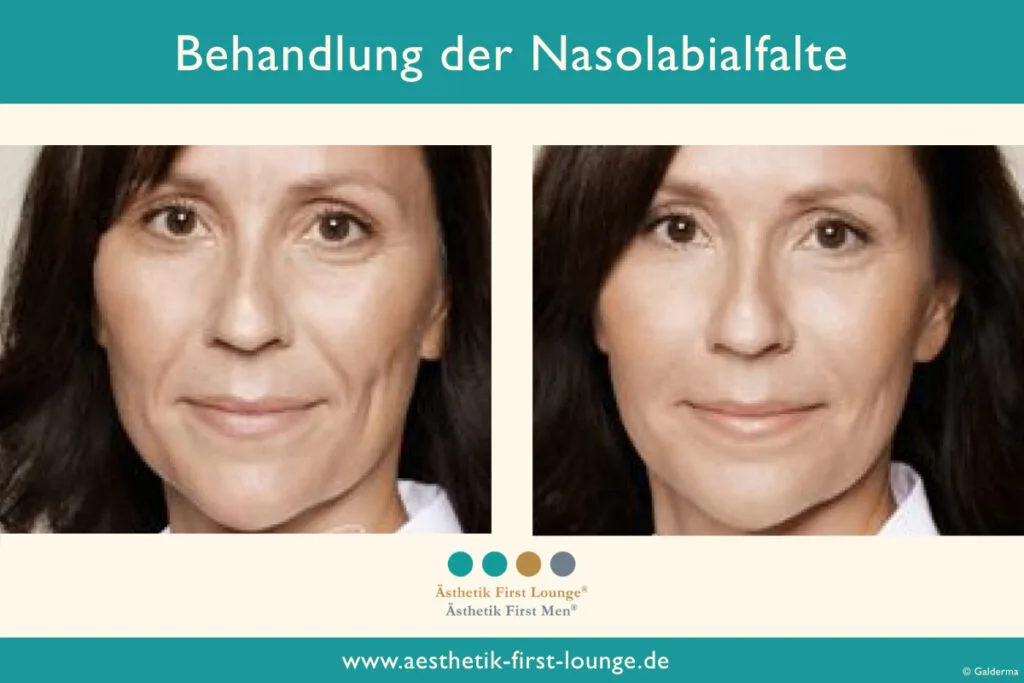 Nasolabialfalte unterspritzen mit Hyaluron Beispiel 6 | Ästhetik First Lounge