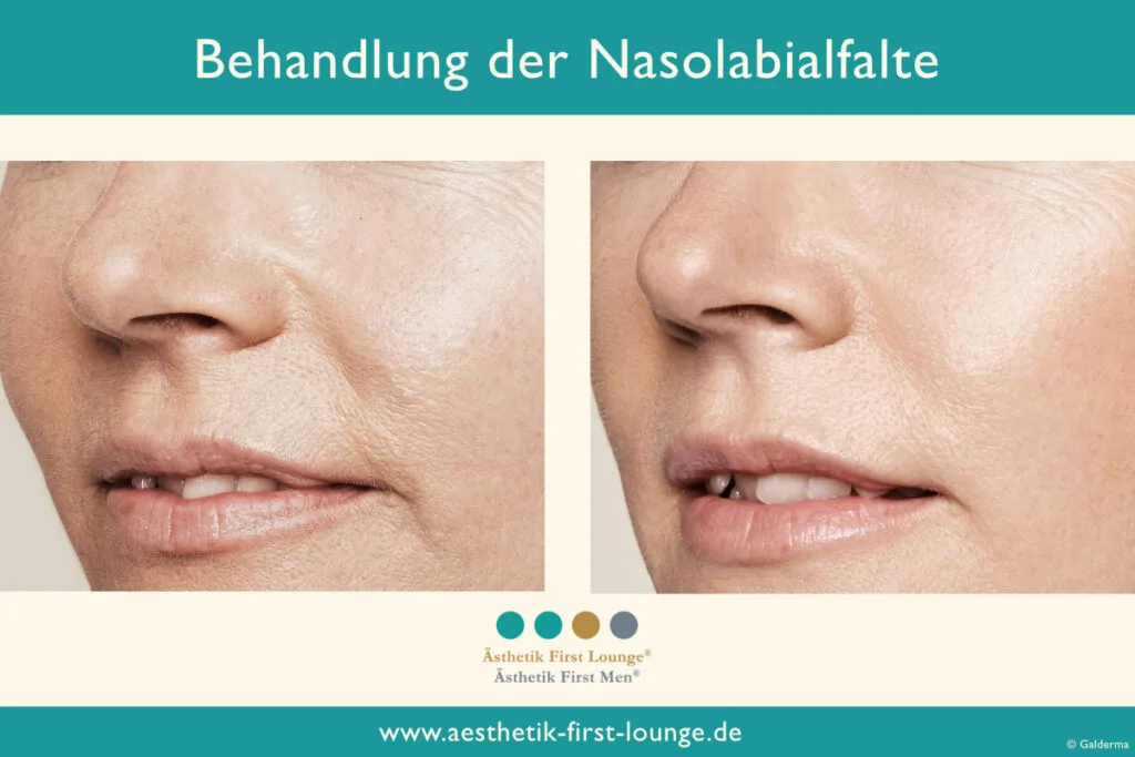Nasolabialfalte unterspritzen mit Hyaluron Beispiel 7 | Ästhetik First Lounge