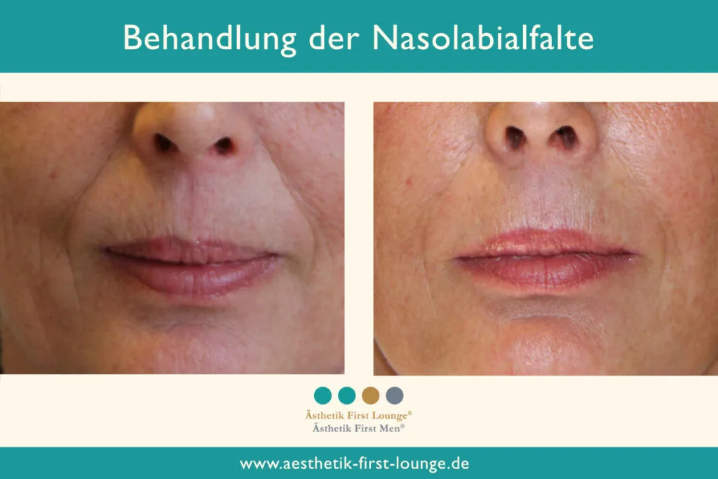 Nasolabialfalte unterspritzen mit Hyaluron Beispiel 1 | Ästhetik First Lounge