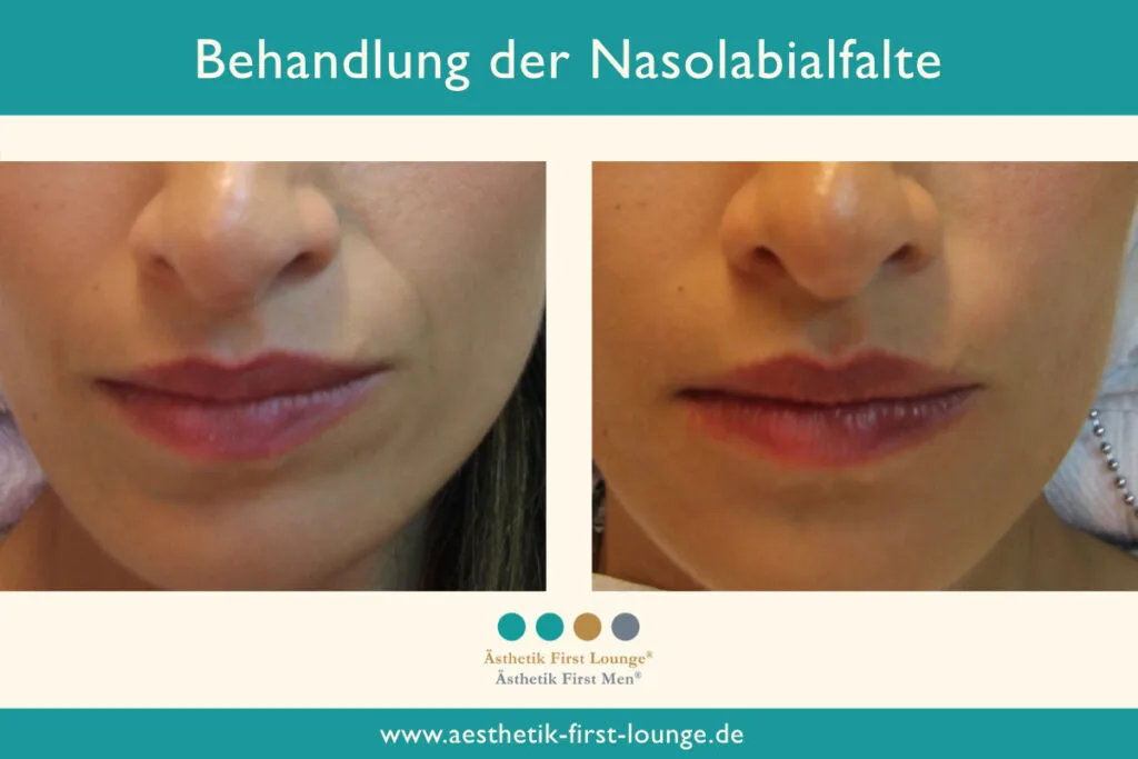 Nasolabialfalte unterspritzen mit Hyaluron Beispiel 3 | Ästhetik First Lounge
