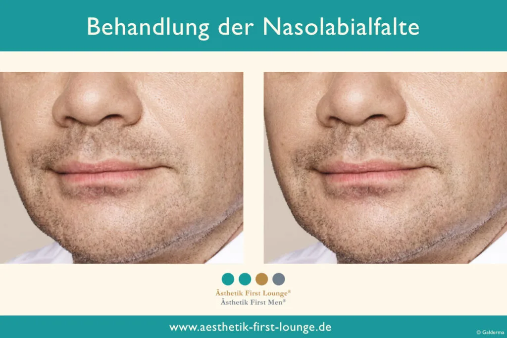 Nasolabialfalte unterspritzen mit Hyaluron Beispiel 8 | Ästhetik First Lounge