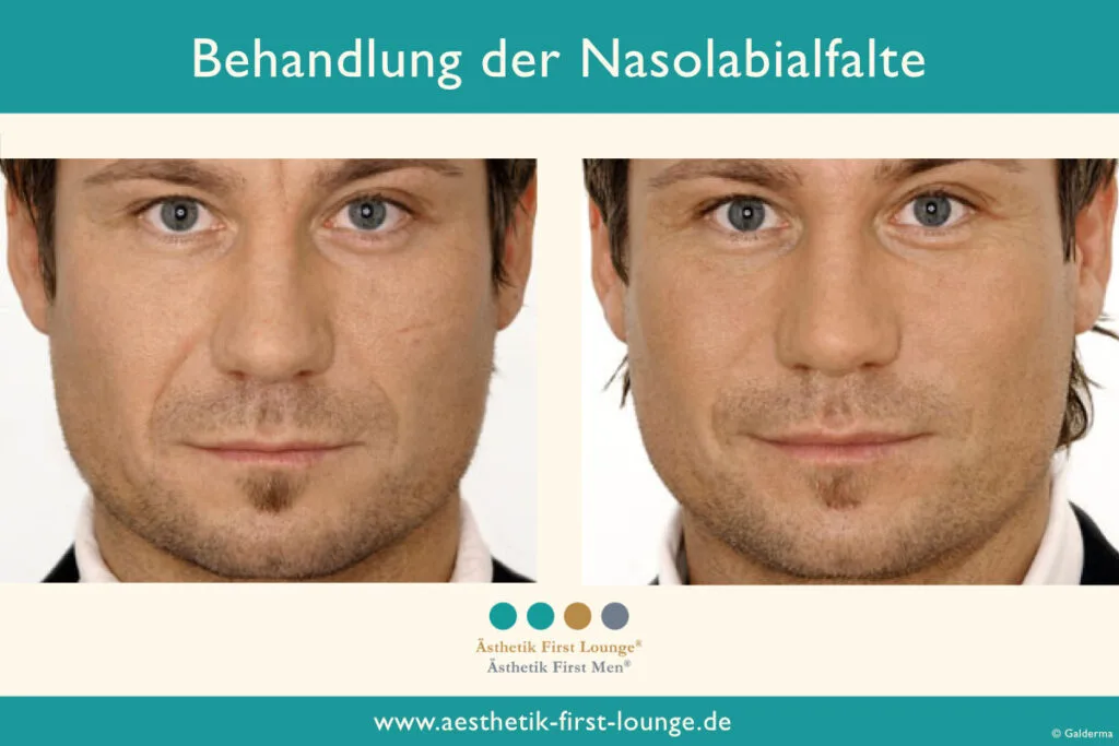 Nasolabialfalte unterspritzen mit Hyaluron Beispiel 9 | Ästhetik First Lounge