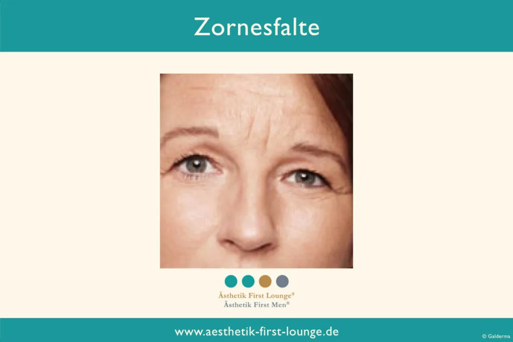 Vorher_nachher_marionettenfalten