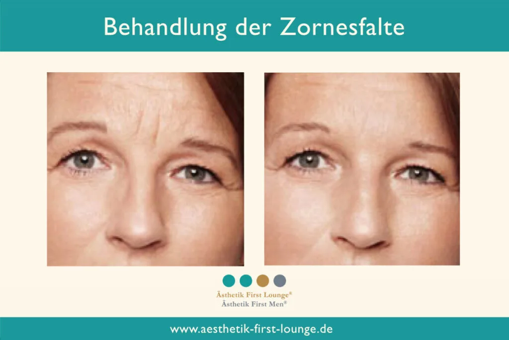 Vorher_nachher_marionettenfalten