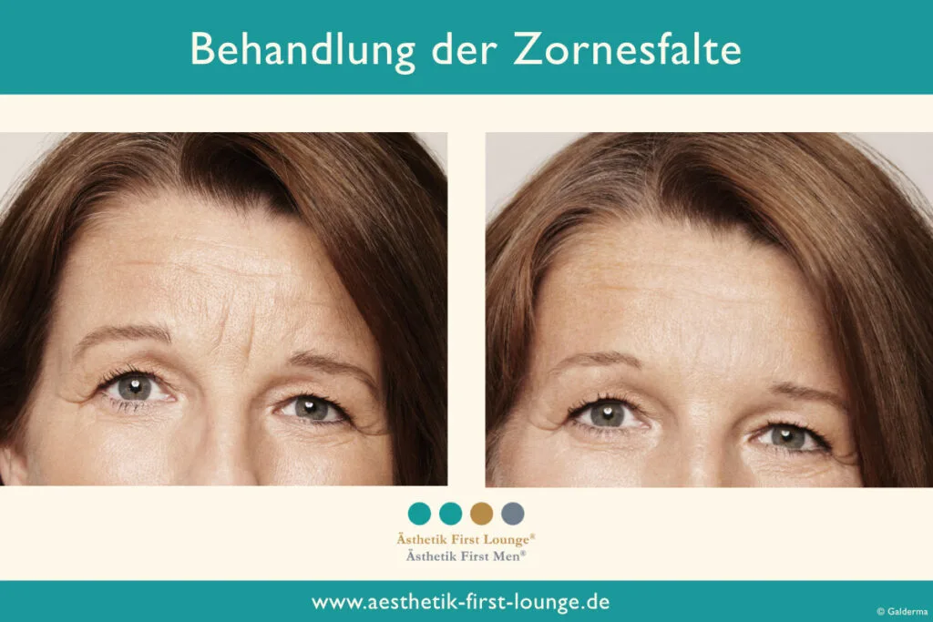 Vorher_nachher_marionettenfalten