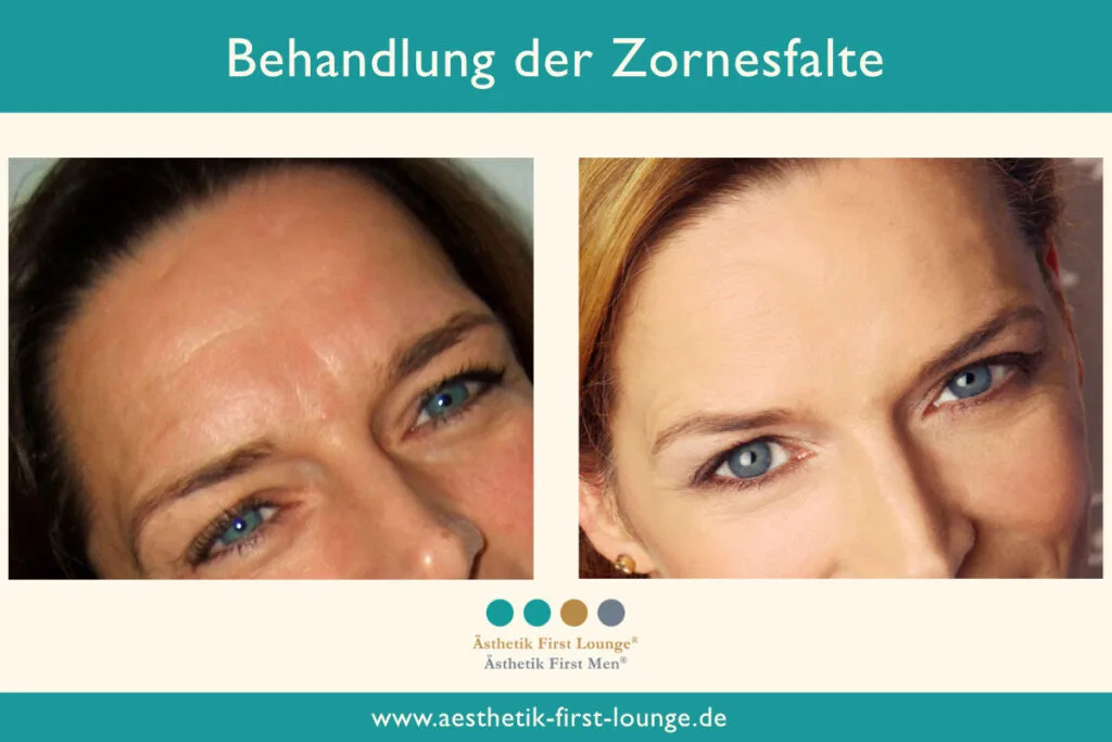 Vorher_nachher_marionettenfalten