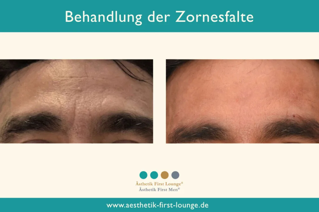 Vorher_nachher_marionettenfalten