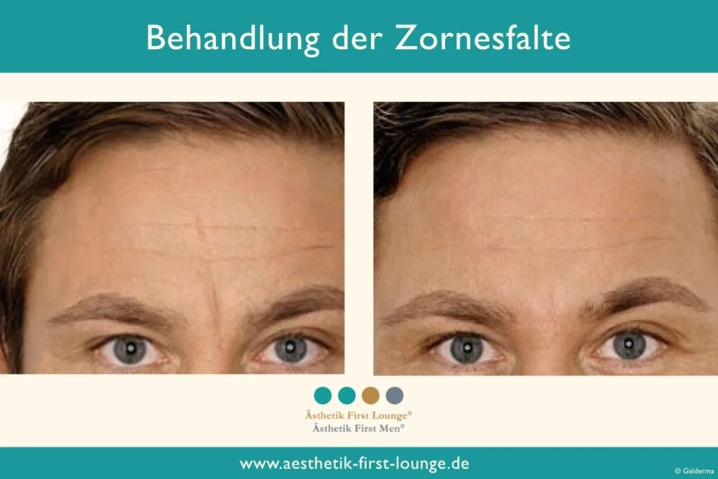 Vorher_nachher_marionettenfalten